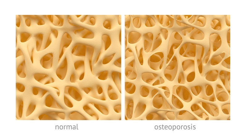 osso com estrutura normal e com estrutura na osteoporose
